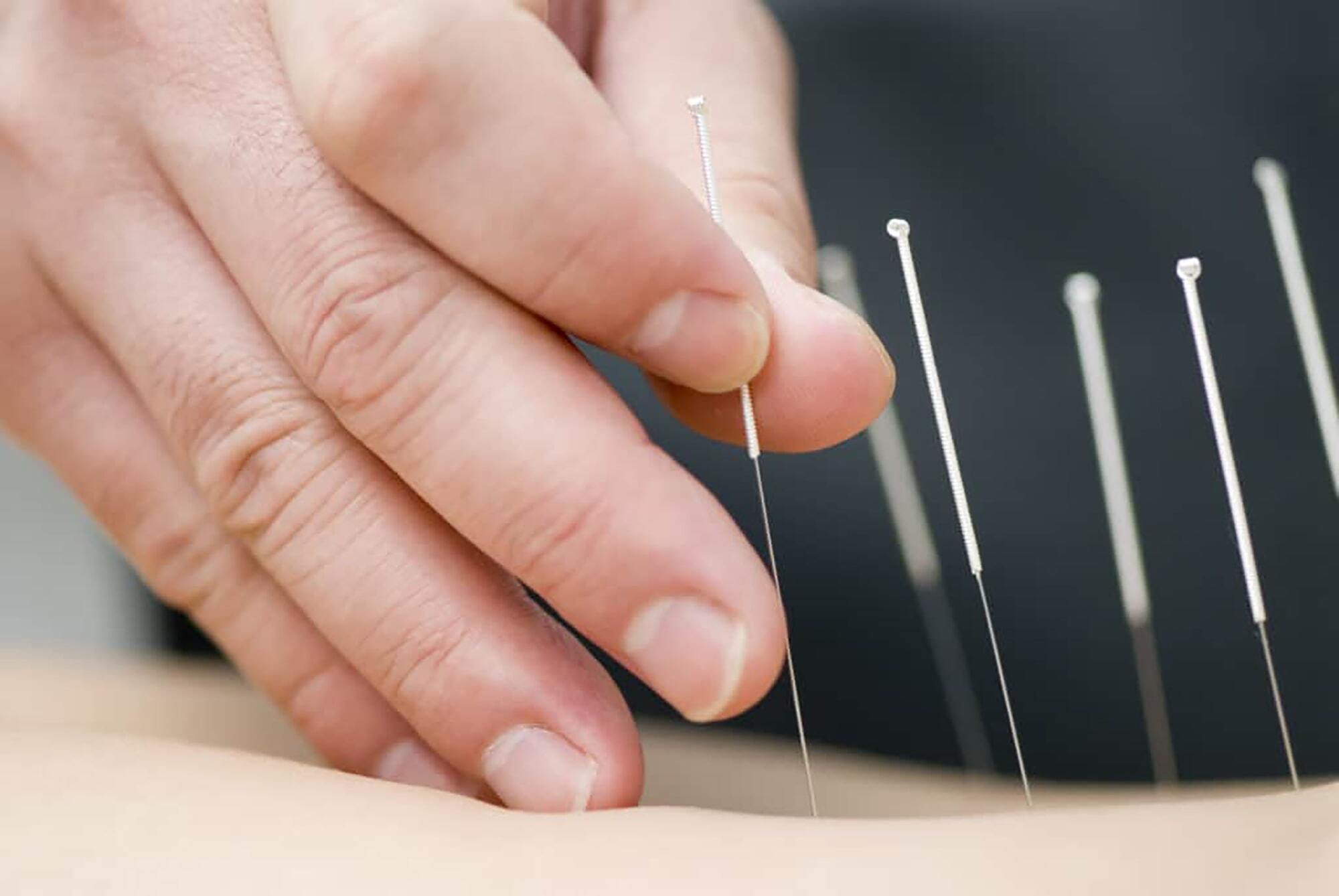 Acupuncture2 min min 1