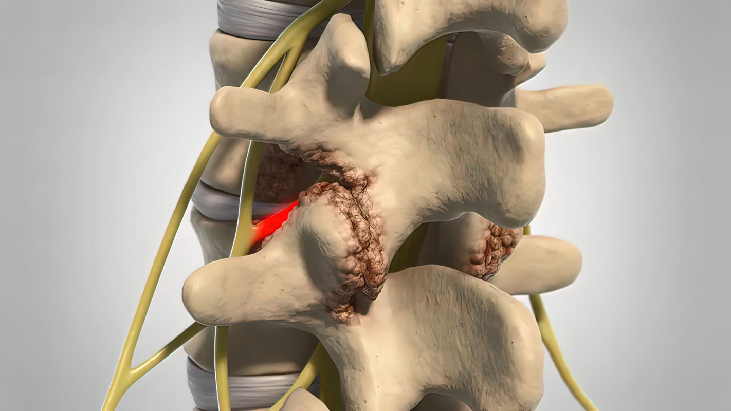 Stenosis