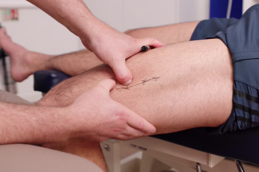 Chiropractor performing thigh fascial release therapy on a patient’s upper leg at a Surbiton chiropractic clinic.