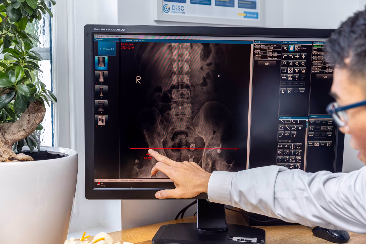 patients xray results chiropractor surbiton