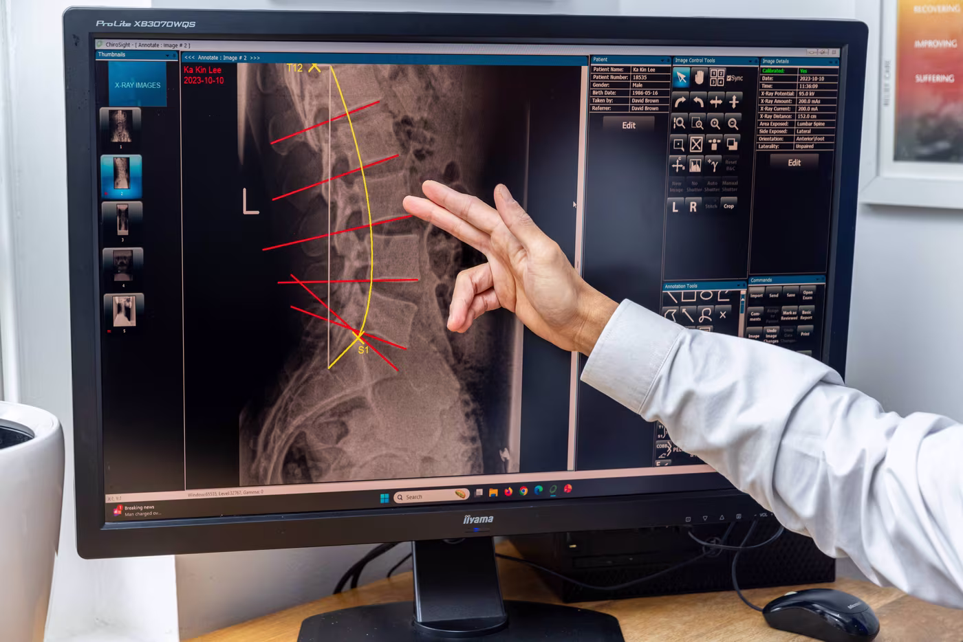 xray review chiropractor disc analysis